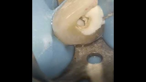 Calcium hydroxide placement in endodontics