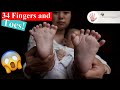 Most Fingers and Toes in the World: 34 on 1 Person! Meet the TOP 4! ~ Body Bizarre!