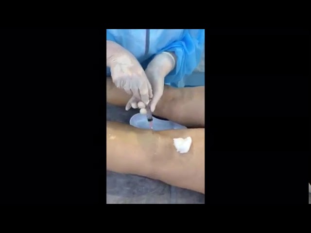 Пункция кисты Бейкера (киста коленного сустава)