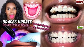 I ACCIDENTALLY DYED MY CLEAR BRACES PINK!! | Come With Me To Get My Bottom Braces On | Braces Update
