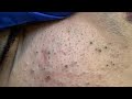 FACIAL TREATMENTS for a PIMPLE-FREE COMPLEXION...