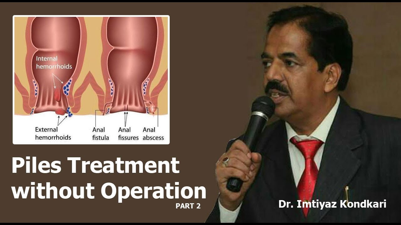 Treatment of Piles without Operation Part 2 YouTube