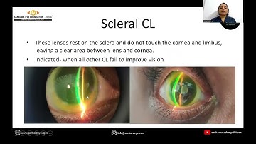 Contact lenses option in keratoconus
