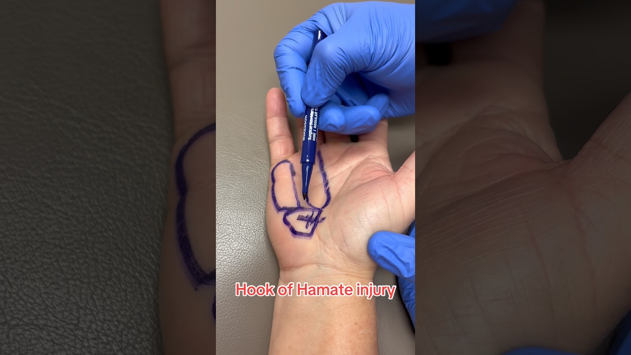Unique hand injury - Hook of the Hamate 