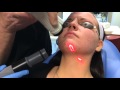 Recovery After CO2 Laser Facial