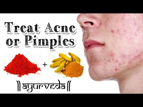 How to Treat Acne or Pimples | Red Sandalwood | Ayurveda Tip