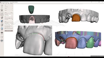 Four Approaches to Single Tooth Segmentation in Meshmixer