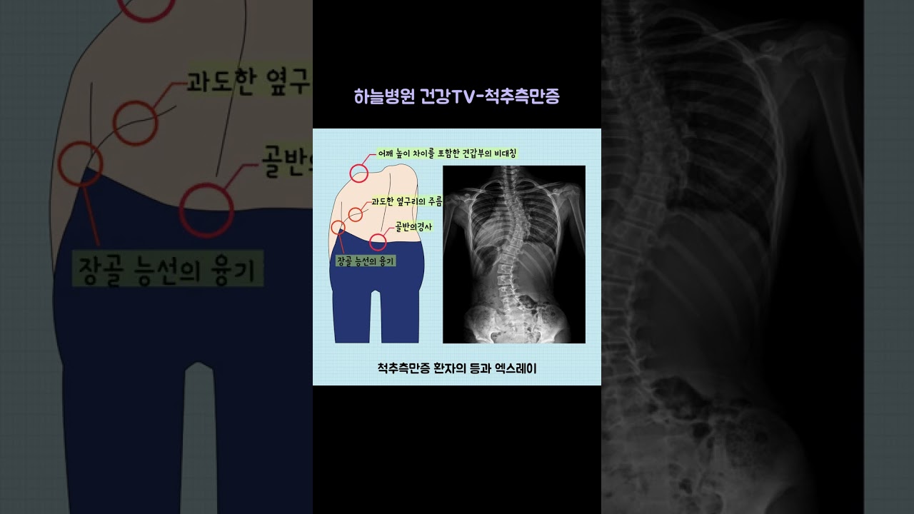 광주척추측만증 초기증상을 확인해보세요! 5