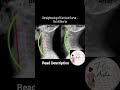 #neckpain #cervicalpain #fyp #painrelief #physiotherapy #physiotherapist #physio #learn #xray #viral