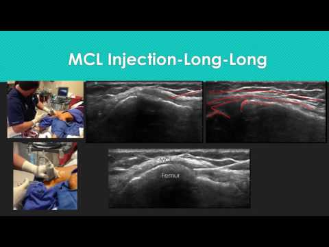 Knee Level 2 MCL Under Ultrasound