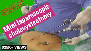 Mini laparoscopic cholecystectomy - Dr Deepraj Bhandarkar