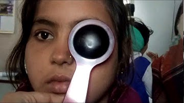 COVER TEST. Alternate esotropia . (ocular examination) 👁‍🗨