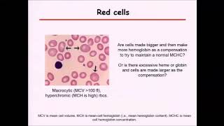Myelodysplastic syndrome (MDS) and anemia