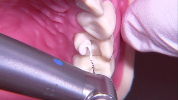 Core build-up with plastic filling material and intraradicular retention - Part 1