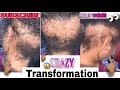 (#66) Amazing Alopecia Transformation (SHE SAID SHE REALLY WANTED THIS HAIR STYLE SOOO BAD SO I DID