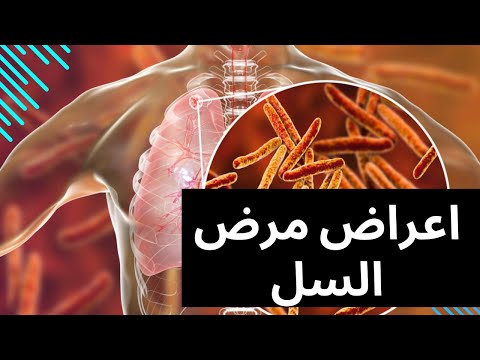 اعراض مرض السل أعراض مرض السل علامات مرض السل أعراض الدرن اعراض السل