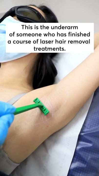 Laser Hair Removal - Results After 8 Treatments