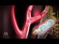 3D Medical Animation (HD) - Stroke Management