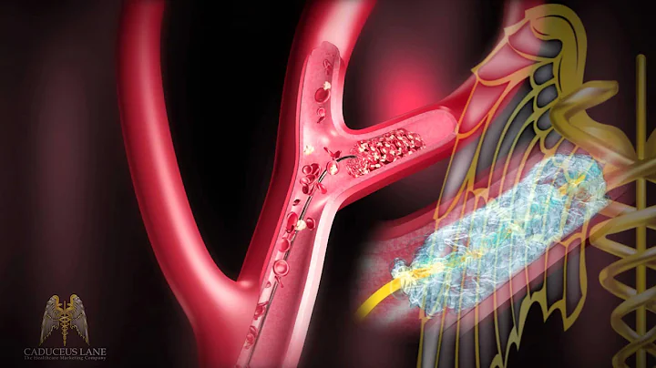 3D Medical Animation (HD) - Stroke Management