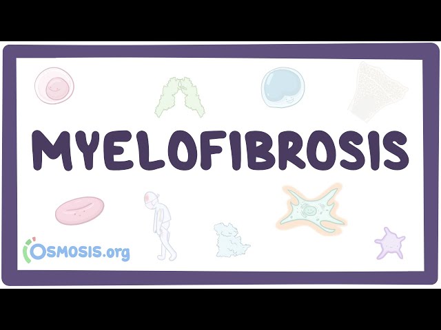 Myelofibrosis Causes Symptoms Diagnosis Treatment Pathology