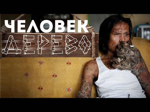 Человек-дерево | Самая странная болезнь