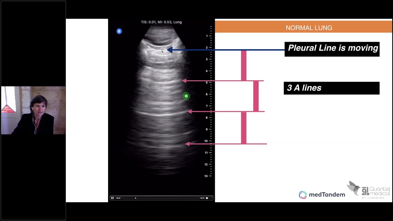 Webinar - Lung ultrasound: Signs on pulmonary ultrasound - YouTube