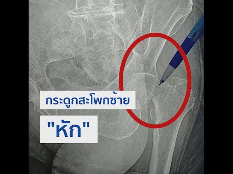 อุบัติเหตุ "ล้ม" กระดูกสะโพกซ้าย "หัก" แต่หลังผ่าตัด 12 ชั่วโมงกลับมาเดินได้ ! l Vejthani Hospital