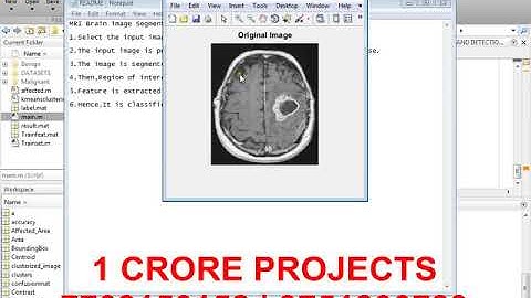 MRI Brain image Segmentation and Classification A Review - 1Crore Projects