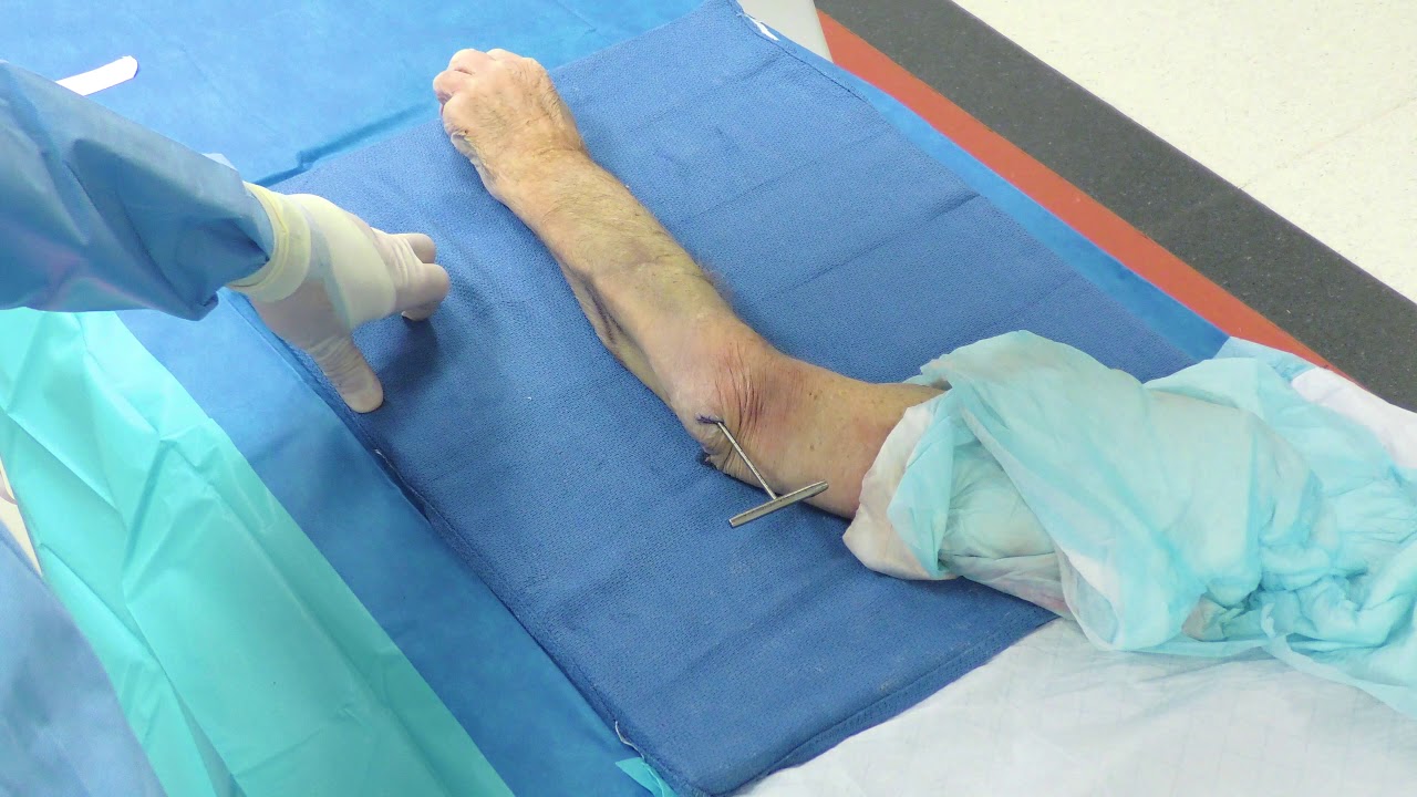 Ulna Fracture Treatment Using the Ulna Rod, with Dr. Richard YouTube