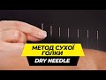 Метод сухої голки/Dry Needle/ Відповіді на найпоширеніші запитання
