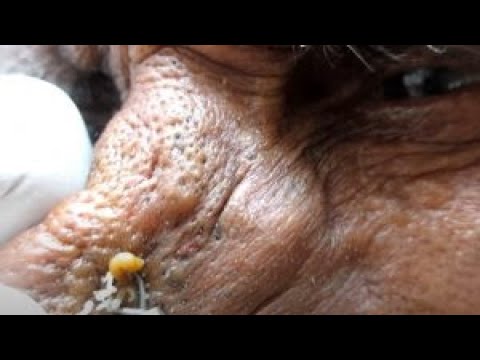 An entire lifetime, whole 55 year old blackhead