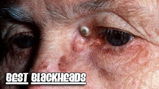 Reddit Top Pops, Volume 3 - Best Blackheads & Dilated Pores