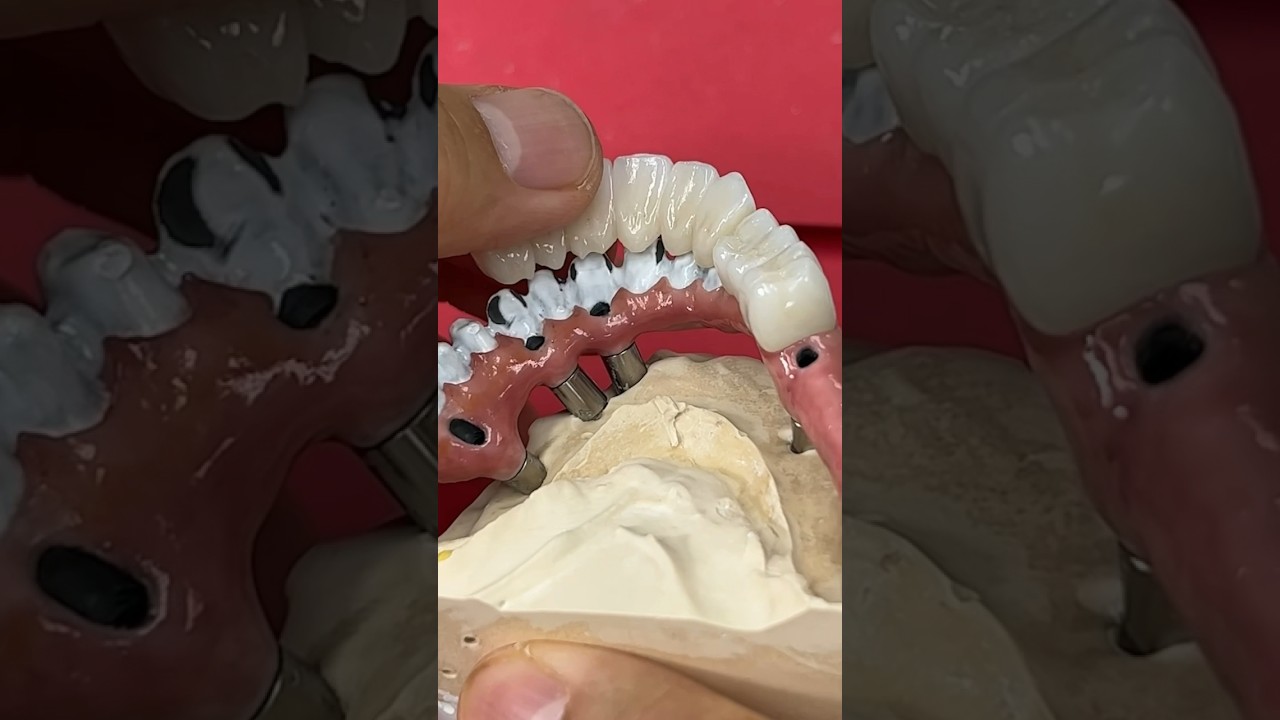 Creating Unique Esthetics #dental #dentist #shorts #short #shortsvideo #shortvideo #dentallab #smile