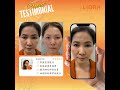Grace Tan Exosome Treatment