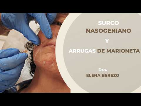 Surco Nasogeniano y arrugas de marioneta en clínicas EB