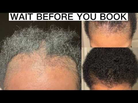Hair Transplant in Turkey: Travel Tips I Wish I Knew Before Going Solo | Part 2