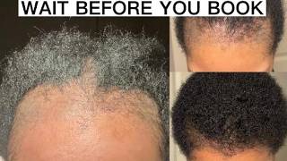 Hair Transplant in Turkey: Travel Tips I Wish I Knew Before Going Solo | Part 2