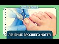 #НАЗДОРОВЬЕ: лечение вросшего ногтя