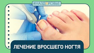 #НАЗДОРОВЬЕ: лечение вросшего ногтя