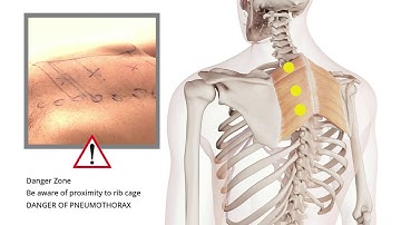 Trigger Point Release | Shoulder Pain | Rhomboids