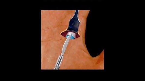 Trigger Finger Surgery