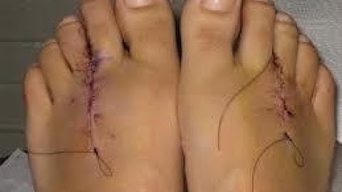 Excision of Neuroma CPT code - simplify medical coding
