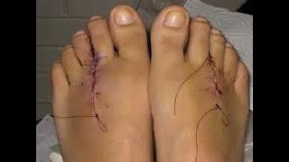 Excision of Neuroma CPT code - simplify medical coding
