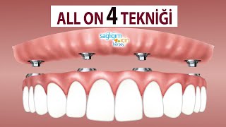 Diş İmplantlarında 'All On 4 Tekniği'