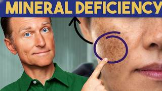 The #1 Deficiency Behind Aging Spots || Dr. Eric Berg