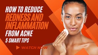 HOW TO REDUCE REDNESS AND INFLAMMATION FROM ACNE: 5 SMART TIPS