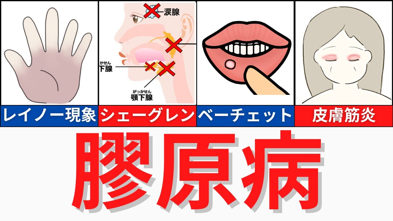 【10分で解説】膠原病について解説　SLE・関節リウマチ以外　17:10は読み間違いです💦胸腺ではなく涙腺が正解です🙏