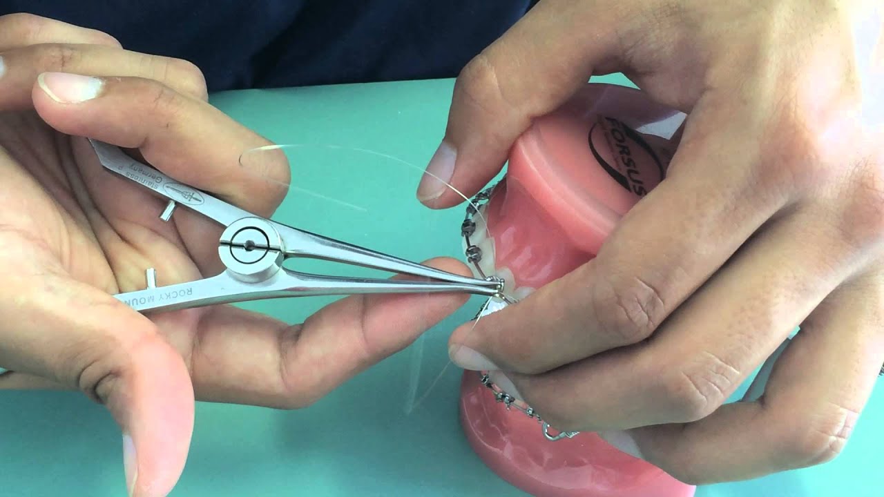 Forsus How To - Setting dell'arco torque e intrusione