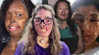 4 bellas mujeres que terminaron desfiguradas | Historias Reales  