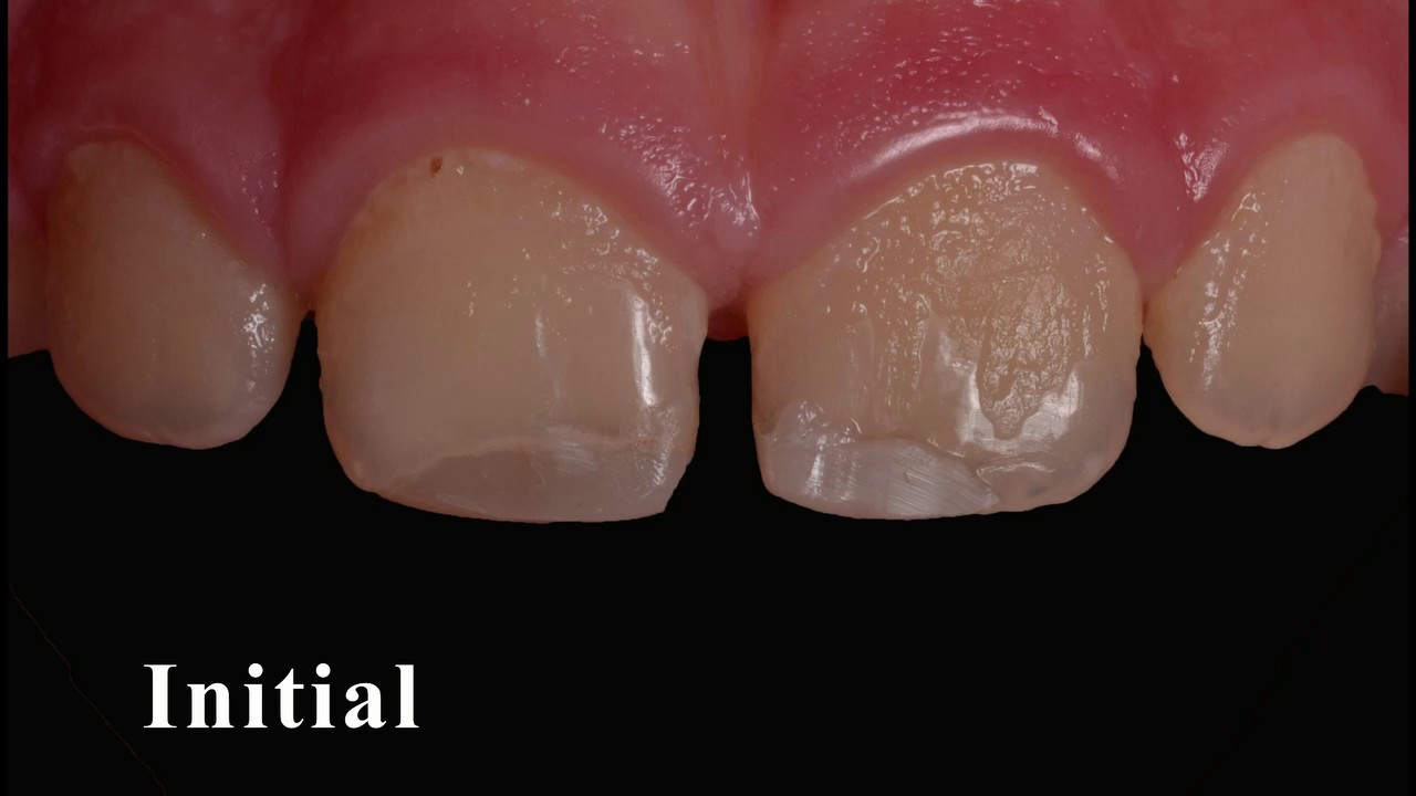 Front teeth fillings replacement YouTube